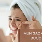 Mụn Gạo Có Nặn Được Không? 